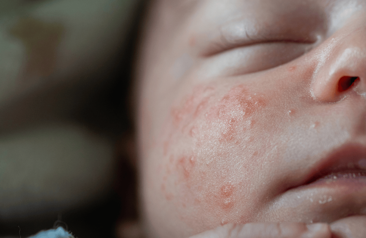 baby acne